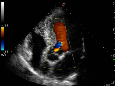 Clinical Image - MyLab<sup>™</sup>Eight Platform - Heart (Color-Aorta)