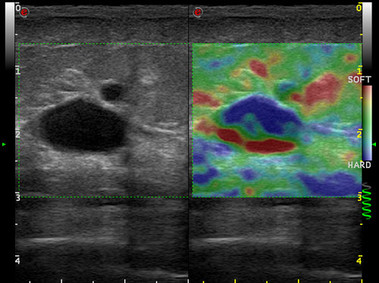 Clinical Image - MyLab<sup>™</sup>Alpha - Dual Mode Strain-based Elastography