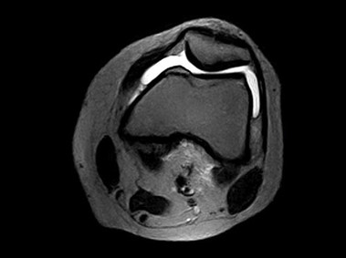 O-scan - Knee FSE T2 Axial