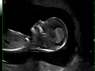 Clinical Image - MyLab<sup>™</sup>Twice - Linear Imaging - (Probe NT)