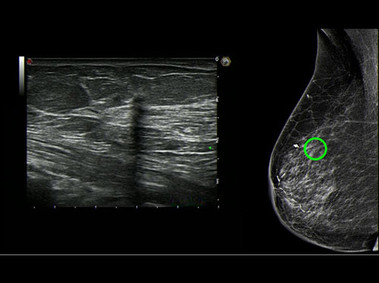 Clinical Image - MyLab<sup>™</sup>Eight Platform - BodyMap with Mammography