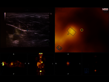 Clinical Image - MyLab<sup>™</sup>Eight eXP - PET-guided Fine Needle Aspiration with real-time ultrasound