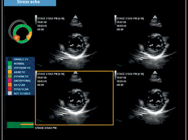 Klinisches Bild - MyLab<sup>™</sup>X5: Stress echo