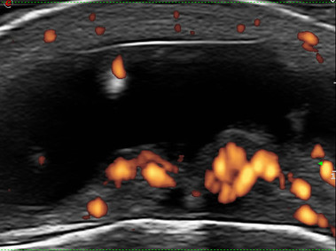Clinical Image - MyLab<sup>™</sup>Alpha - Bursitis