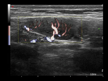 Image clinique - MyLab<sup>™</sup>Alpha - Rein (Imagerie XFlow)