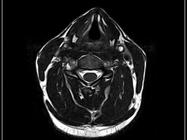 G-scan Brio - CSpine - 3D Hyce Axial