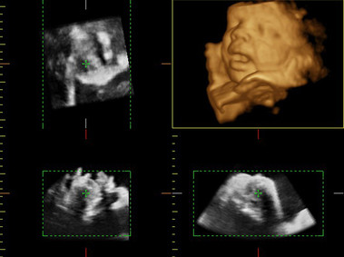 Clinical Image - MyLab<sup>™</sup>Twice - Baby Face (X4D Imaging)