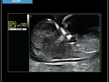 Clinical Image - MyLab<sup>™</sup>X6: AutoNT