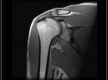 G-scan Brio - Shoulder - FSE PD Coronal