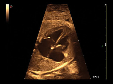 Clinical Image - MyLab<sup>™</sup>Alpha - Heart (HD Zoom Imaging)