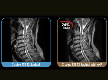 S-scan - C-spine FSE T2 Sagittal with eXP