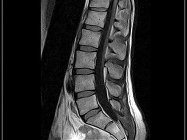 G-scan Brio - LSpine - SE T1 Sagittal