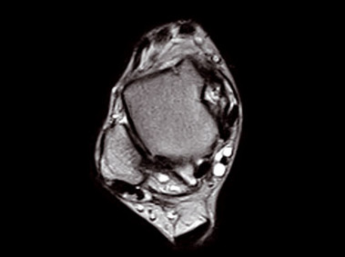 O-scan - Ankle FSE T2 Axial