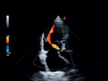 Immagine clinica - MyLab<sup>™</sup>Six - Insufficienza della valvola cardiaca (Imaging CFM)