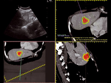 Clinical Image - MyLab<sup>™</sup>Twice - Liver Lesion Treatment (Fusion Imaging)
