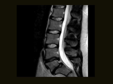 S-scan - L-spine FSE T2 Sagittal