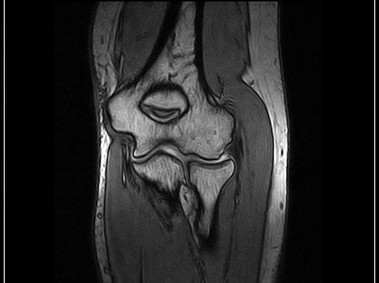 O-scan - Elbow - 3D Sharc Coronal