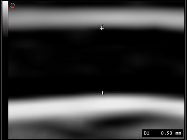 Clinical Image - MyLab<sup>™</sup>9 Platform - High Frequency MSK Imaging with HD Zoom