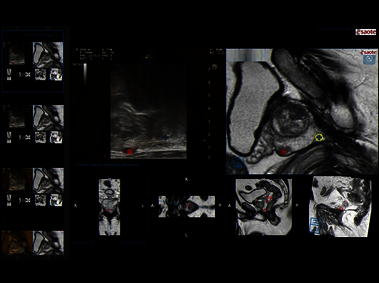 Clinical Image - MyLab<sup>™</sup>Eight eXP - Targeted prostate biopsy