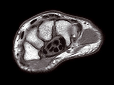 O-scan - Wrist SpinEcho T1 Axial