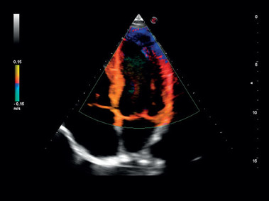 Immagine clinica - MyLab<sup>™</sup>Gamma - Doppler del tessuto cardiaco (imaging TVM)