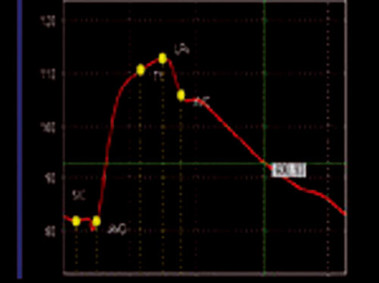 Clinical Image - MyLab<sup>™</sup>Twice - Carotid Artery