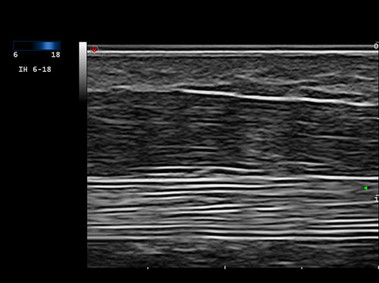 Clinical Image - MyLab<sup>™</sup>Twice - High Frequency Imaging