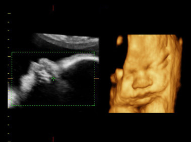 Clinical Image - MyLab<sup>™</sup>Twice - Baby Face (X4D Imaging)