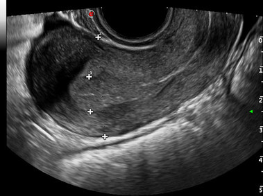 Clinical Image - MyLab<sup>™</sup>Eight Platform - Gynaecology - (B-mode)