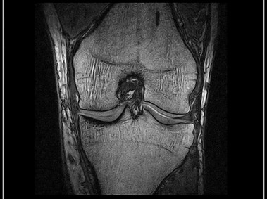 O-scan - Knee - 3D SHARC ISO Coronal