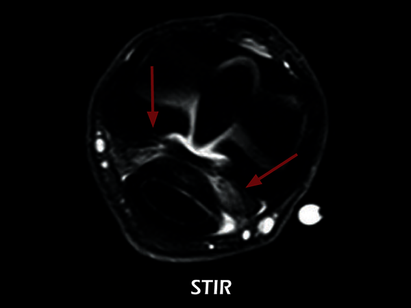 Clinical Image - O-scan equine: Fetlock Arthropathy