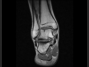 G-scan Brio - Ankle - SE T1 Coronal