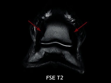 Clinical Image - O-scan equine: Lesion of the collateral ligaments of the coffin joint