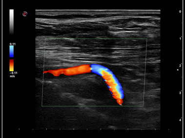 Klinische Bildgebung – MyLab<sup>™</sup>9 Platform – Ultraempfindlicher Farbdoppler zur Erkennung der Vertebralarterie