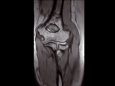O-scan - Elbow 3D SHARC Coronal