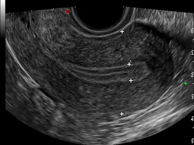 Clinical Image - MyLab<sup>™</sup>Eight Platform - Gynaecology - (B-mode)