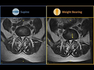 G-scan Brio - Facet Joint Instability