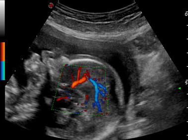 Clinical Image - MyLab<sup>™</sup>Twice - Power Doppler - B-mode