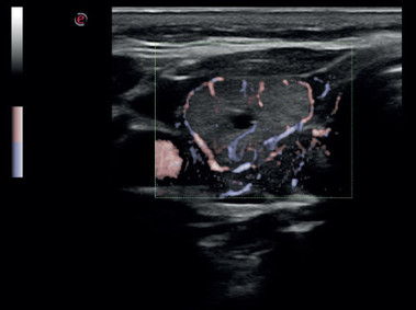 Immagine clinica - MyLab<sup>™</sup>Six - Vascolarizzazione della tiroide (Imaging XFlow)