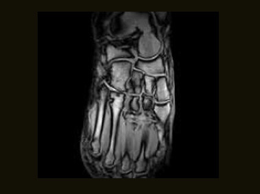 S-scan - Foot GE T1 Coronal