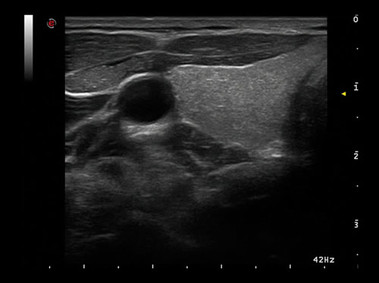 Image clinique - MyLab<sup>™</sup>Alpha - Artère carotide (Imagerie XView et MView)