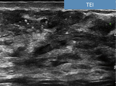 Clinical Image - MyLab<sup>™</sup>Seven - TEI<sup>™</sup>Imaging