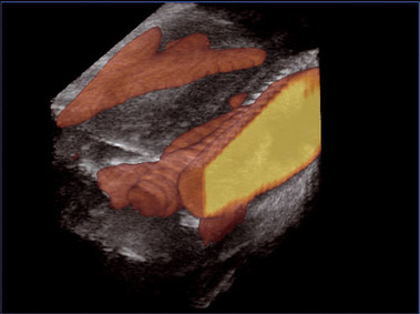 Clinical Image - MyLab<sup>™</sup>Twice - Carotid Artery (4D view)