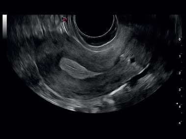 Immagine clinica - MyLab<sup>™</sup>Six - Utero (TEI&amp;trade; - MView - Imaging XView )