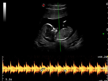 Clinical Image - MyLab<sup>™</sup>Seven - Extended Trapezioidal Linear Imaging