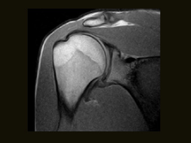 S-scan - Shoulder SE T1 Coronal