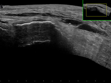 Clinical Image - MyLab<sup>™</sup>Alpha - Wrist Cyst