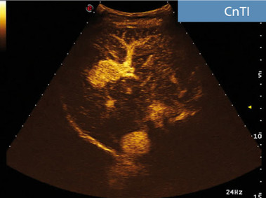 Clinical Image - MyLab<sup>™</sup>Seven - CnTI<sup>™</sup> Imaging