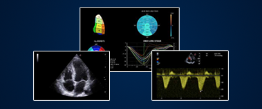 COVID-19 and the Heart