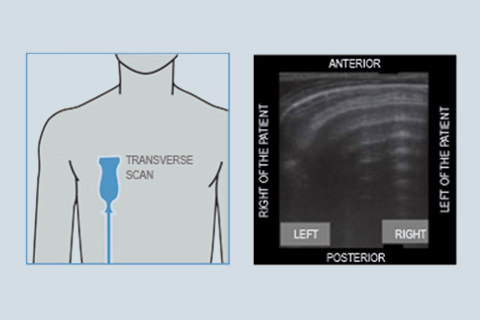Lung Ultrasound (LUS) in Critical Care